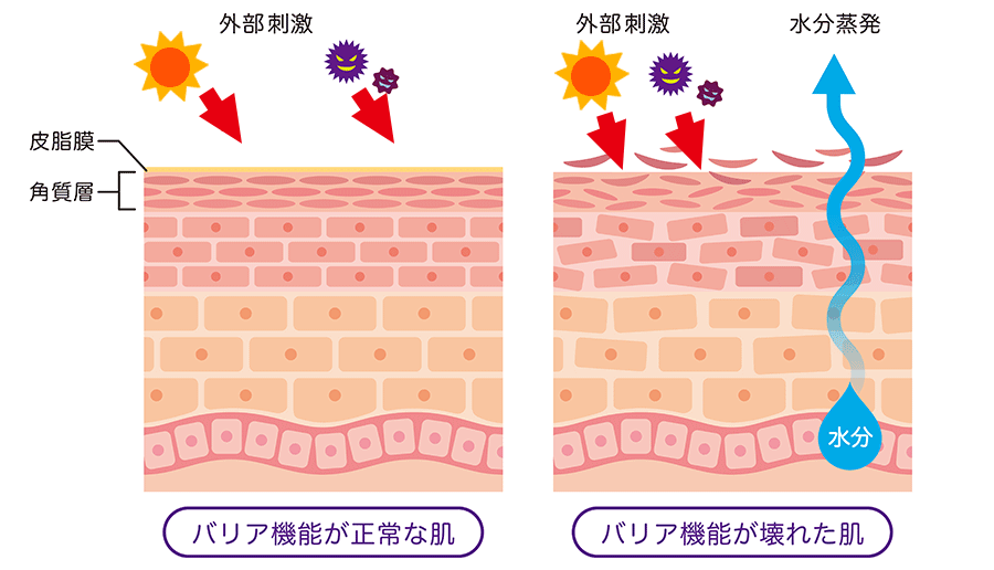 肌トラブルの原因は乾燥と紫外線